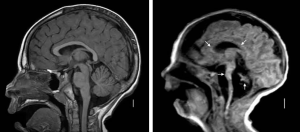 Comparaison entre un cerveau sain et un cerveau atteint par la maladie de Rose, illustrant les différences visibles entre les deux.